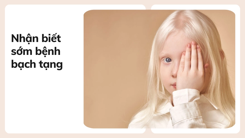 Dấu hiệu nhận biết bệnh bạch tạng sớm nhất