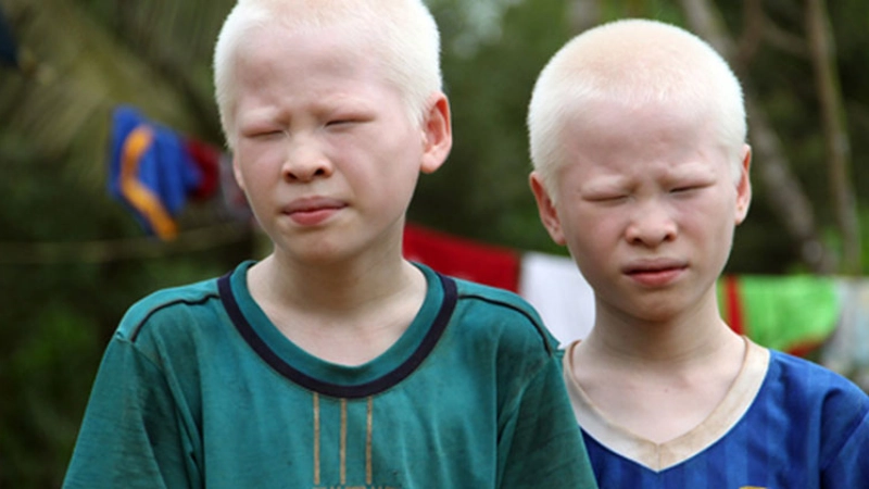 Bệnh bạch tạng có nguy hiểm không?