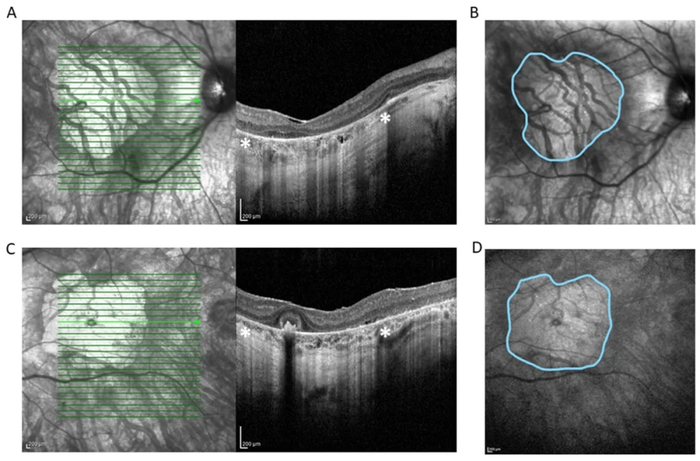 Triệu chứng bệnh thiếu máu hồng cầu hình liềm do đột biến gen