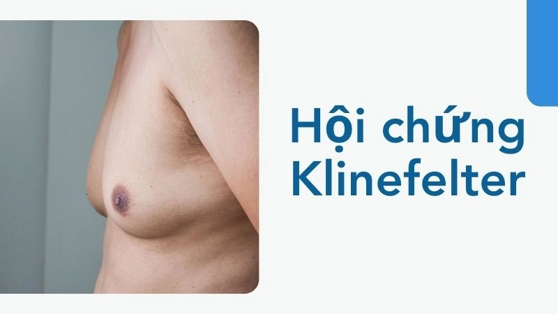 Klinefelter - Khi nhiễm sắc thể X trở nên thừa thãi
