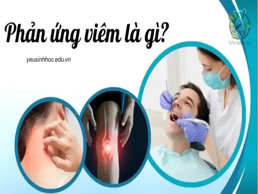 Phản ứng viêm là gì? Cơ chế và tác động đến sức khỏe con người