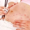 Bà bầu bị ngứa khắp người phải làm sao? Nguyên nhân và cách giảm ngứa hiệu quả