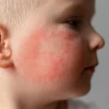 Bé bị nổi mẩn đỏ khắp người không sốt: Nguyên nhân và cách xử lý hiệu quả