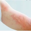 Bé Bị Nổi Mề Đay Khắp Người: Nguyên Nhân, Cách Xử Lý và Phòng Ngừa Hiệu Quả