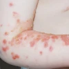 Bệnh chốc lở ở người lớn: Nguyên nhân, dấu hiệu và cách điều trị hiệu quả