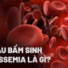 Bệnh Thalassemia ở người lớn: Dấu hiệu nhận biết và cách quản lý hiệu quả