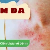 Bị hăm mông ở người lớn: Nguyên nhân, cách nhận biết và phòng ngừa hiệu quả