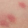 Bị hăm nách ở người lớn: Nguyên nhân, cách nhận biết và giải pháp khắc phục hiệu quả