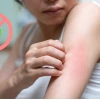 Bị Nấm Mèo ở Người Kiêng Ăn Gì và Cách Điều Trị Hiệu Quả