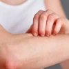 Bị ngứa khắp người không rõ nguyên nhân: Nguyên nhân và cách xử lý