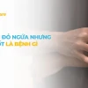 Bị Nổi Ban Đỏ Khắp Người: Nguyên Nhân, Dấu Hiệu và Cách Xử Lý