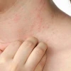 Bị nổi mẩn đỏ khắp người và ngứa: Nguyên nhân, cách xử lý và phòng ngừa
