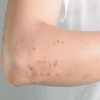 Bị nổi mề đay ngứa khắp người: Nguyên nhân, dấu hiệu và cách xử lý hiệu quả