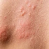 Biểu hiện HIV ngoài da: Nhận biết sớm các dấu hiệu bất thường