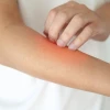 Bọ nhảy ở mèo có lây sang người không và cách phòng tránh hiệu quả