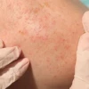 Cách trị nổi sảy ở người lớn hiệu quả và phòng ngừa tái phát