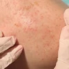 Cách trị rôm sảy ở người lớn tại nhà hiệu quả và nhanh chóng