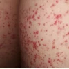 Da nổi chấm đỏ như nốt ruồi son không ngứa: Nguyên nhân và cách xử lý