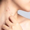 Da nổi mụn khắp người nhưng không ngứa: Nguyên nhân và cách xử lý