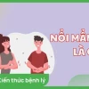 Dị ứng nổi mẩn khắp người: Nguyên nhân, dấu hiệu và cách xử lý hiệu quả
