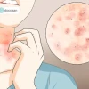 Ghẻ phỏng ở người lớn: Nguyên nhân, triệu chứng và cách điều trị hiệu quả