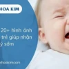 Hình ảnh nấm lưỡi ở người lớn: Nhận biết triệu chứng và cách xử lý hiệu quả