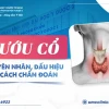 Hình ảnh người bị bướu cổ: Nhận biết sớm qua những dấu hiệu đặc trưng
