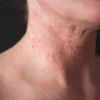 Hình ảnh viêm da cơ địa người lớn: Dấu hiệu nhận biết và giải pháp