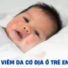 Hình ảnh viêm da cơ địa người lớn: Nhận biết, nguyên nhân và cách điều trị