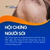 Hội chứng người sói: Nguyên nhân, triệu chứng và cách đối phó