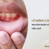 Lở Mồm Ở Người: Nguyên Nhân, Triệu Chứng Và Cách Điều Trị Hiệu Quả
