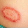 Nấm Đồng Xu Ở Người: Triệu Chứng, Nhận Biết và Cách Điều Trị Hiệu Quả