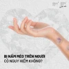 Nấm mèo ở người có tự khỏi không và cách xử lý hiệu quả