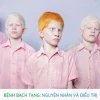 Người Bạch Tạng Ở Việt Nam: Đặc Điểm, Nguyên Nhân Và Cách Chăm Sóc