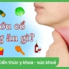 Người bị bướu cổ nên kiêng ăn gì và ăn gì tốt cho tuyến giáp?