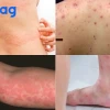 Người Hay Bị Ngứa Là Bệnh Gì? Nguyên Nhân Và Cách Khắc Phục