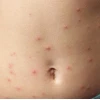 Người mọc mụn nước ngứa: Nguyên nhân và cách xử lý hiệu quả