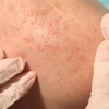Nguyên nhân bị rôm sảy ở người lớn và cách xử lý hiệu quả