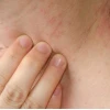 Nổi Ban Đỏ Ngứa Khắp Người: Nguyên Nhân, Cách Xử Lý và Phòng Ngừa
