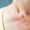 Nổi Ban Đỏ Ngứa Nhưng Không Sốt Ở Người Lớn: Dấu Hiệu, Nguyên Nhân và Cách Xử Lý