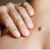 Nổi Cục Cứng Dưới Da: Tìm Hiểu Nguyên Nhân Và Cách Xử Lý Hiệu Quả