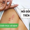 Nổi đốm đỏ trên da: Nguyên nhân, triệu chứng và cách xử lý hiệu quả