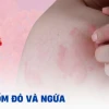 Nổi đốm đỏ trên da và ngứa: Nguyên nhân, triệu chứng và cách xử lý