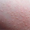 Nổi Hạt Ngứa Khắp Người: Nguyên Nhân, Cách Xử Lý và Phòng Ngừa Hiệu Quả