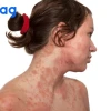 Nổi hột đỏ ngứa khắp người là dấu hiệu bệnh gì và cách xử lý