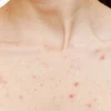 Nổi Mẩn Đỏ Không Ngứa Như Muỗi Đốt: Nguyên Nhân Và Cách Xử Lý Hiệu Quả