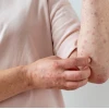 Nổi Mẩn Đỏ Ngứa Khắp Người Là Bệnh Gì? Nguyên Nhân và Cách Xử Lý