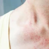 Nổi Mẩn Đỏ Ở Cổ Người Lớn: Nguyên Nhân, Dấu Hiệu Và Cách Xử Lý