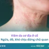Nổi mẩn đỏ ở cổ người lớn: Nguyên nhân, triệu chứng và cách xử lý