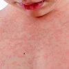 Nổi mẩn đỏ và ngứa khắp người: Nguyên nhân và cách xử lý hiệu quả